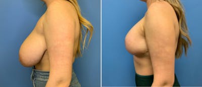 Breast Lift (Mastopexy) Before & After Gallery - Patient 38564961 - Image 1