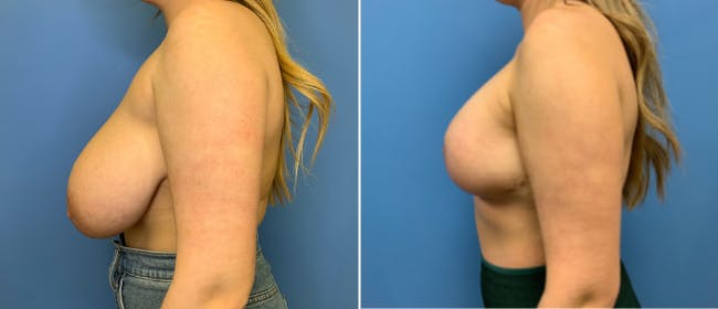 Breast Lift (Mastopexy) Before & After Gallery - Patient 38564961 - Image 1