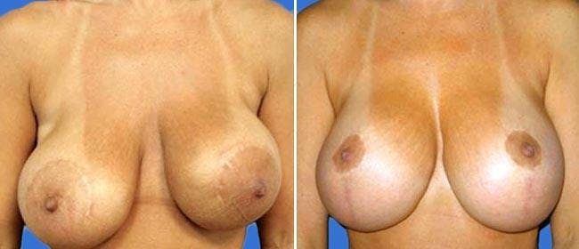 Breast Lift (Mastopexy) Before & After Gallery - Patient 38564964 - Image 1