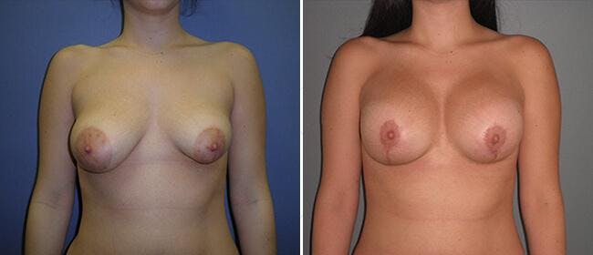 Breast Lift (Mastopexy) Before & After Gallery - Patient 38564969 - Image 1
