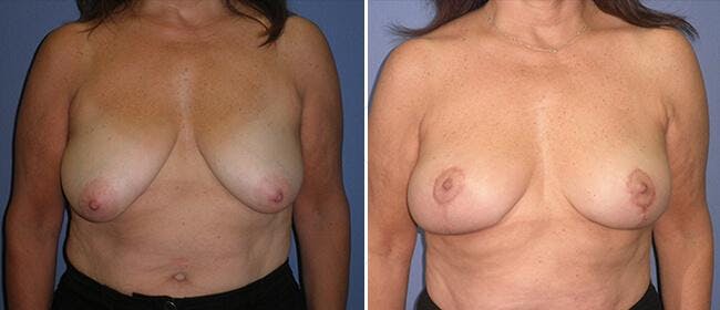 Breast Lift (Mastopexy) Before & After Gallery - Patient 38564972 - Image 1