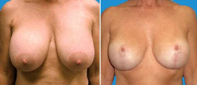 Breast Lift (Mastopexy) Before & After Gallery - Patient 38564973 - Image 1