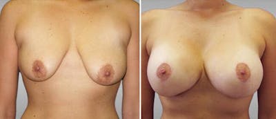 Breast Lift (Mastopexy) Before & After Gallery - Patient 38564977 - Image 1