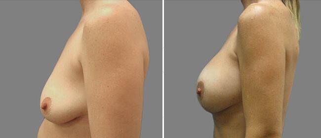 Breast Lift (Mastopexy) Before & After Gallery - Patient 38564981 - Image 1