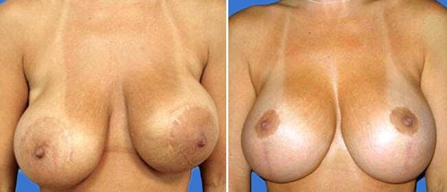 Breast Lift (Mastopexy) Before & After Gallery - Patient 38564982 - Image 1
