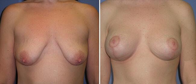 Breast Lift (Mastopexy) Before & After Gallery - Patient 38564986 - Image 1