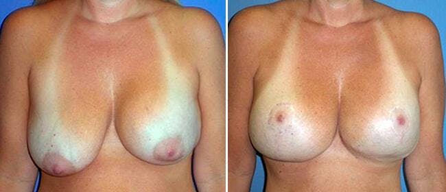 Breast Lift (Mastopexy) Before & After Gallery - Patient 38564990 - Image 1