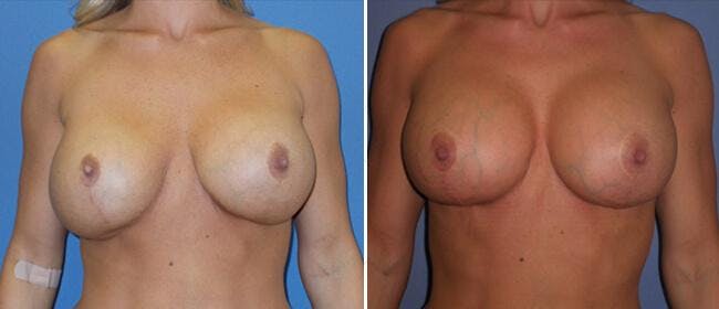 Breast Lift (Mastopexy) Before & After Gallery - Patient 38564994 - Image 1