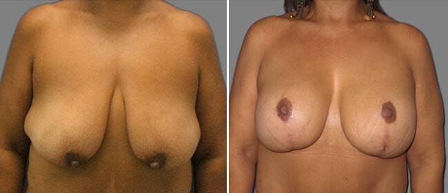 Breast Lift (Mastopexy) Before & After Gallery - Patient 38564996 - Image 1