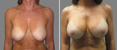 Breast Lift (Mastopexy) Before & After Gallery - Patient 38564998 - Image 1