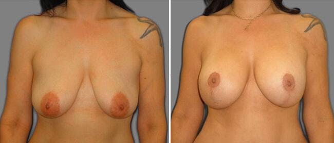 Breast Lift (Mastopexy) Before & After Gallery - Patient 38565007 - Image 1