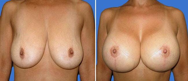 Breast Lift (Mastopexy) Before & After Gallery - Patient 38565009 - Image 1
