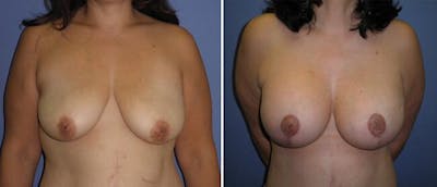 Breast Lift (Mastopexy) Before & After Gallery - Patient 38565011 - Image 1