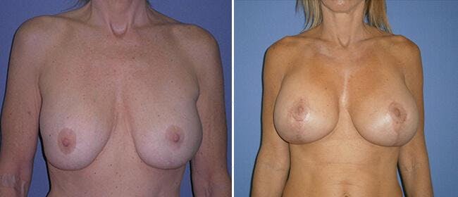 Breast Lift (Mastopexy) Before & After Gallery - Patient 38565015 - Image 1