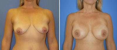 Breast Lift (Mastopexy) Before & After Gallery - Patient 38565017 - Image 1