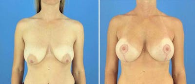 Breast Lift (Mastopexy) Before & After Gallery - Patient 38565021 - Image 1
