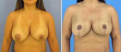 Breast Lift (Mastopexy) Before & After Gallery - Patient 38565023 - Image 1