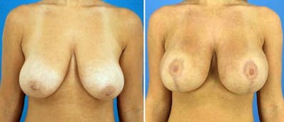Breast Lift (Mastopexy) Before & After Gallery - Patient 38565024 - Image 1
