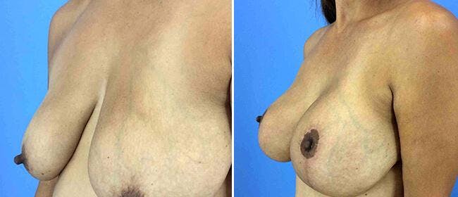 Breast Lift (Mastopexy) Before & After Gallery - Patient 38565026 - Image 1