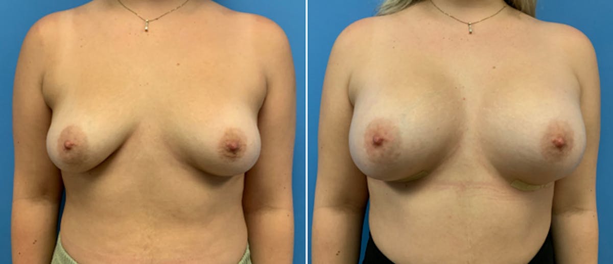Breast Augmentation Before & After Gallery - Patient 38566297 - Image 1