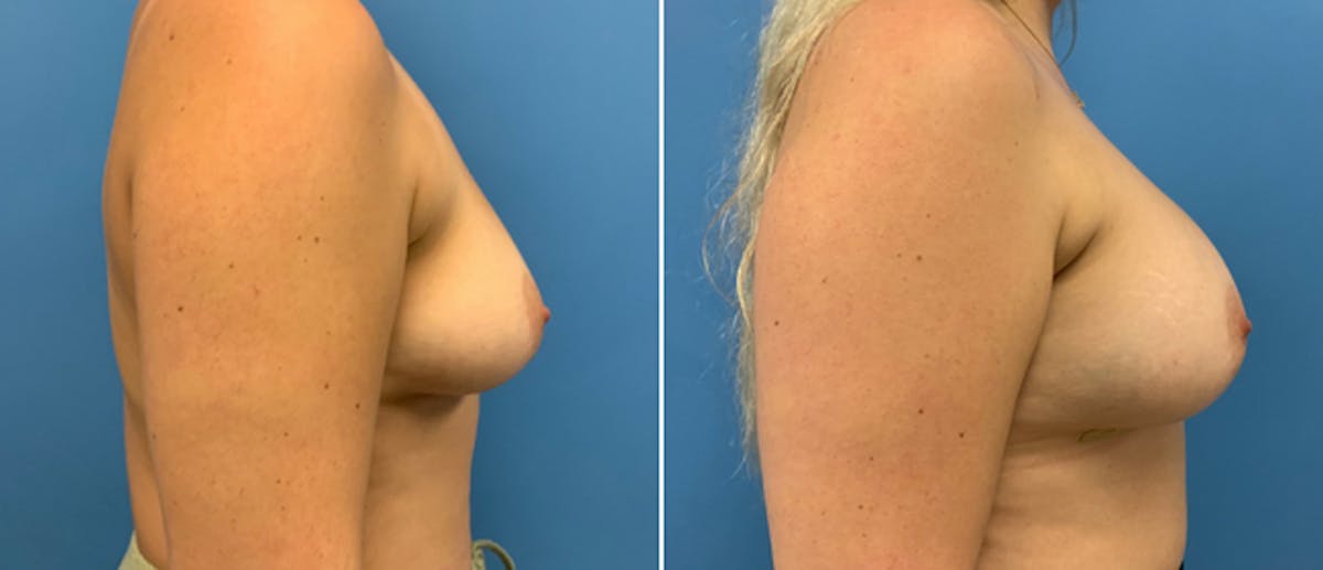 Breast Augmentation Before & After Gallery - Patient 38566297 - Image 2