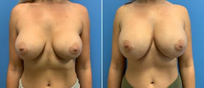 Breast Augmentation Before & After Gallery - Patient 38566300 - Image 1