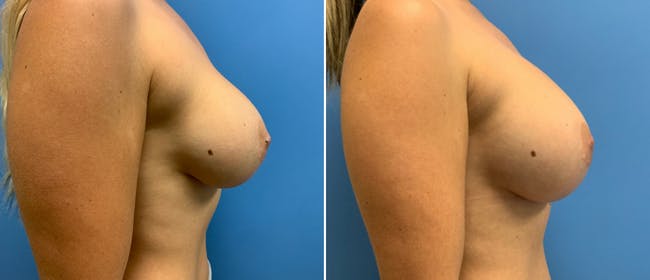 Breast Augmentation Before & After Gallery - Patient 38566300 - Image 2