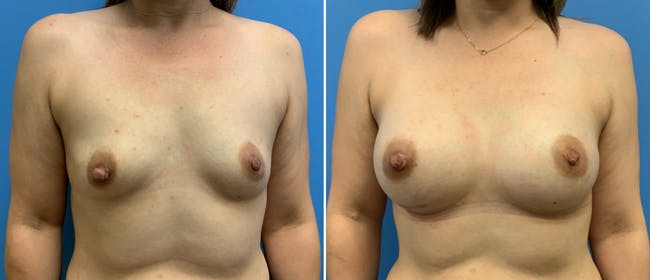 Breast Augmentation Before & After Gallery - Patient 38566302 - Image 1