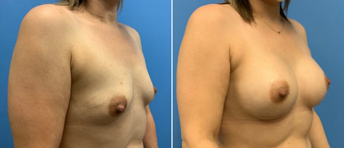 Breast Augmentation Before & After Gallery - Patient 38566302 - Image 2