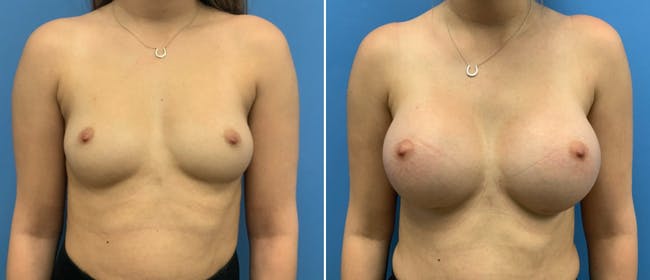 Breast Augmentation Before & After Gallery - Patient 38566306 - Image 1