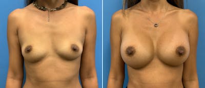Breast Augmentation Before & After Gallery - Patient 38566309 - Image 1