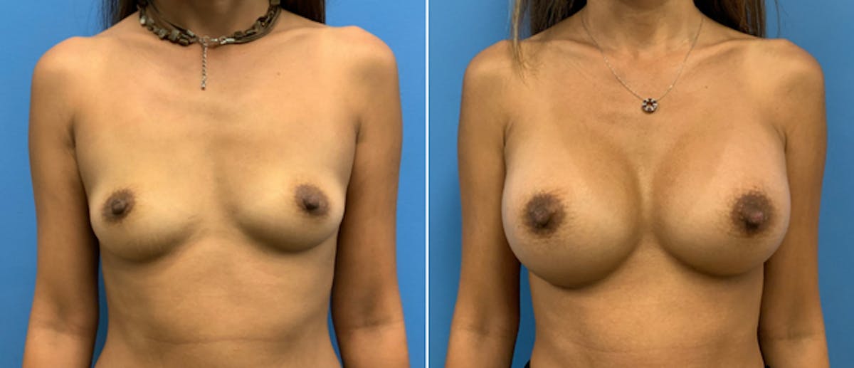 Breast Augmentation Before & After Gallery - Patient 38566309 - Image 1