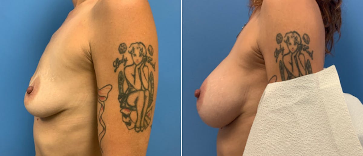 Breast Augmentation Before & After Gallery - Patient 38566310 - Image 2