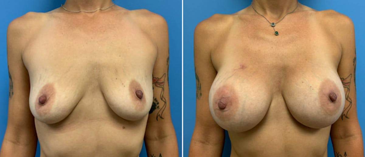 Breast Augmentation Before & After Gallery - Patient 38566310 - Image 1