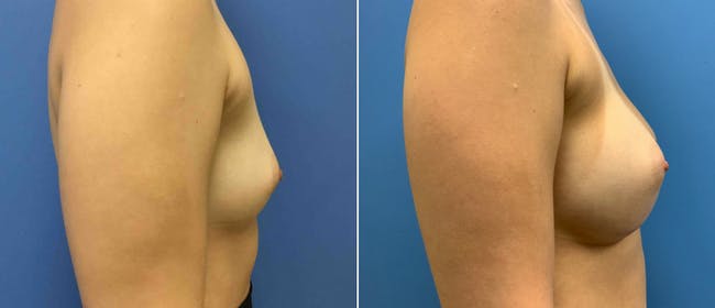 Breast Augmentation Before & After Gallery - Patient 38566313 - Image 2