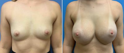 Breast Augmentation Before & After Gallery - Patient 38566313 - Image 1