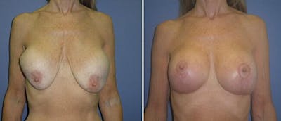 Breast Reconstruction Before & After Gallery - Patient 38566316 - Image 1