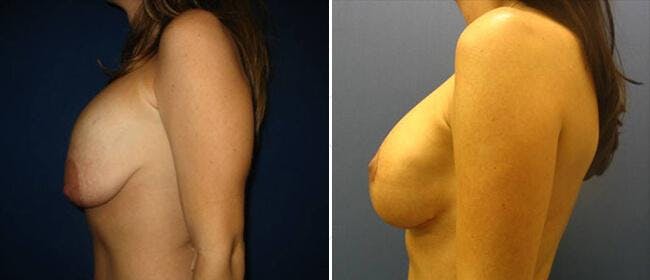 Breast Reconstruction Before & After Gallery - Patient 38566318 - Image 1