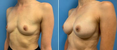 Breast Augmentation Before & After Gallery - Patient 38566321 - Image 1
