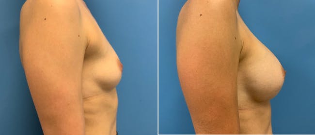 Breast Augmentation Before & After Gallery - Patient 38566321 - Image 2