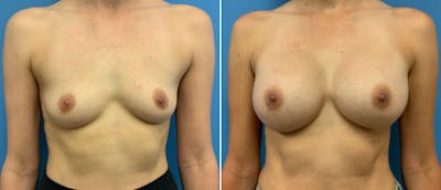 Breast Augmentation Before & After Gallery - Patient 38566323 - Image 1
