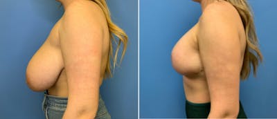 Breast Reduction Before & After Gallery - Patient 38566326 - Image 1