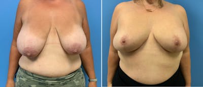 Breast Reduction Before & After Gallery - Patient 38566328 - Image 1
