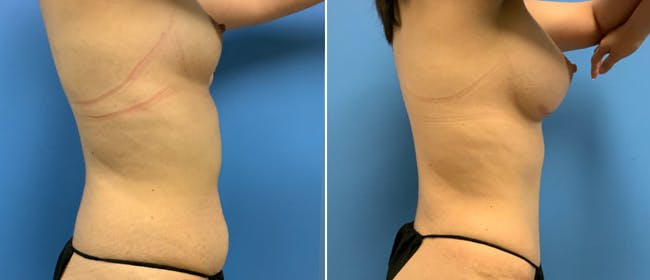 Breast Augmentation Before & After Gallery - Patient 38566327 - Image 3