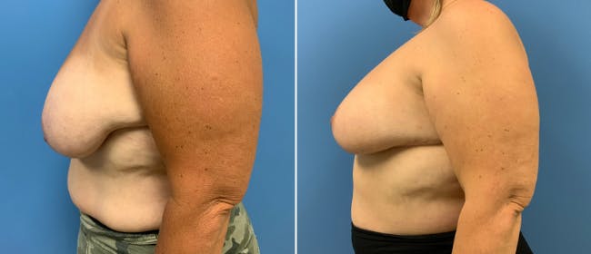 Breast Reduction Before & After Gallery - Patient 38566328 - Image 2