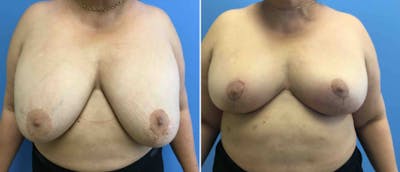Breast Reduction Before & After Gallery - Patient 38566333 - Image 1