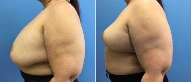 Breast Reduction Before & After Gallery - Patient 38566333 - Image 2