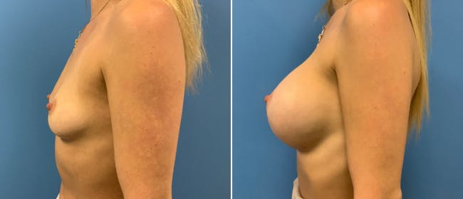 Breast Augmentation Before & After Gallery - Patient 38566337 - Image 2