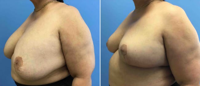 Breast Reduction Before & After Gallery - Patient 38566333 - Image 3