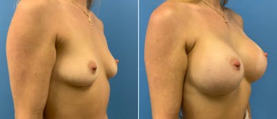 Breast Augmentation Before & After Gallery - Patient 38566337 - Image 1